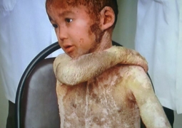 Мальчик «с чешуей» едет на лечение в Израиль