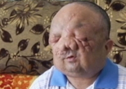В Испании жителю Семея удалили огромную опухоль на лице