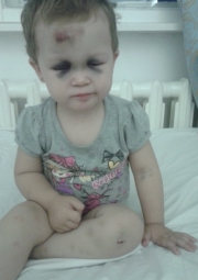 Двухлетняя кызылординка получила тяжелые травмы в детском саду, «ударившись об мягкую мебель»