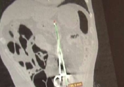 Карагандинский хирург дважды забыл инструменты в теле пациента