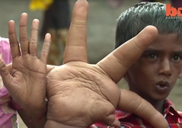 Врачи уменьшили индийскому мальчику гигантскую руку (ВИДЕО)