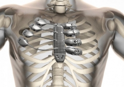 Больному пересадили грудину и рёбра, распечатанные на 3D-принтере в Испании