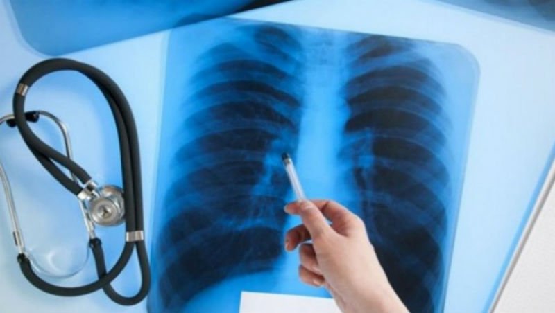 Пять случаев заболевания туберкулезом выявлено среди учителей в Нур-Султане