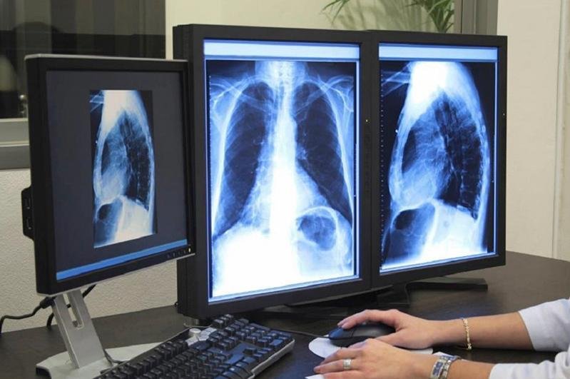 Медсақтандыру: Өкпеге компьютерлік томографияны тегін жасату неліктен қиын