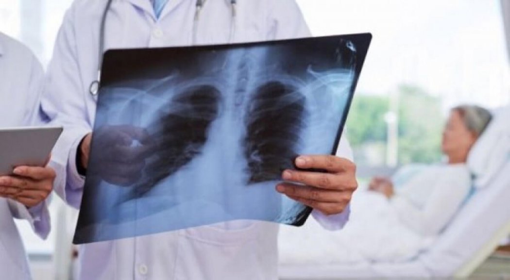 Алматылық дәрігерлер пневмониядан өкпесінің 96%-ы зақымдаған әйелді аман алып қалды