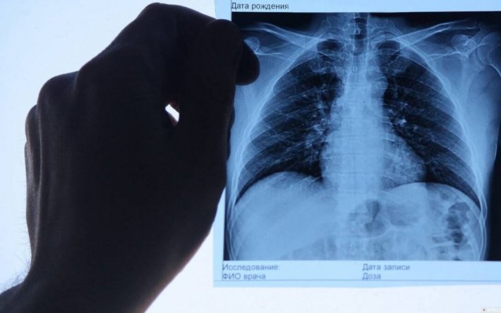 14 медиков скончались от пневмонии в Актюбинской области