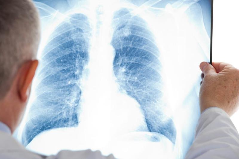 За прошедшие сутки зафиксированы 159 случаев заболевания пневмонией с признаками КВИ