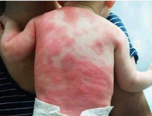 Казахстанцы обсуждают фото младенца, сделанное якобы через 24 часа после вакцинации