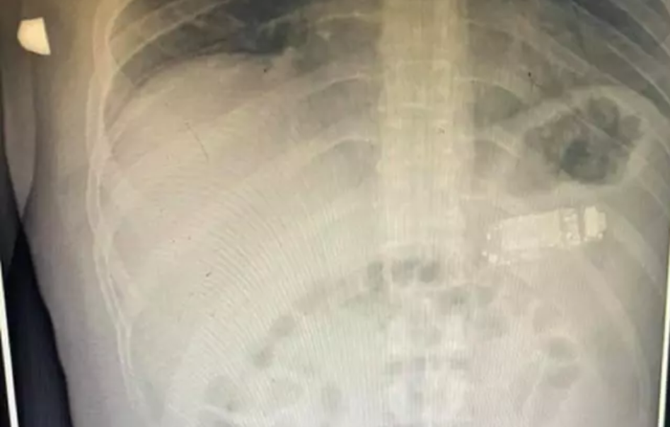 Ескі ұялы телефонды жұтып қойған азамат дәрігерлерді таңғалдырды (фото)